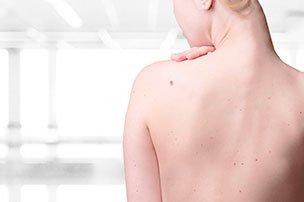 Меланоцитарные образования кожи в общей практике