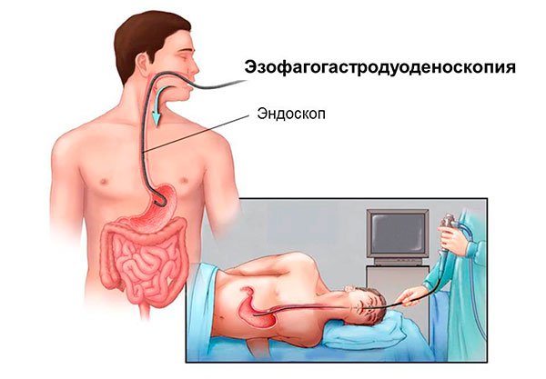 Эзофагогастродуоденоскопия