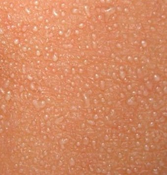 Водянистые образования на коже – причины, симптомы и лечение везикул на коже