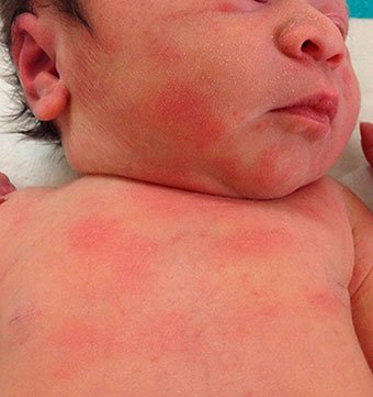 Гормональная сыпь у новорожденных и грудничков: признаки и лечение – статьи от АО Медицина